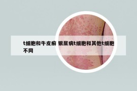 t细胞和牛皮癣 银屑病t细胞和其他t细胞不同