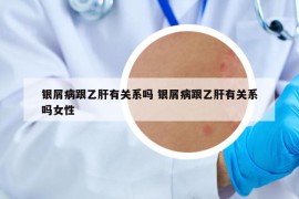 银屑病跟乙肝有关系吗 银屑病跟乙肝有关系吗女性