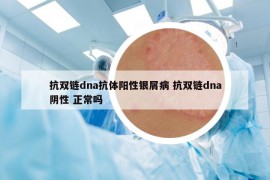 抗双链dna抗体阳性银屑病 抗双链dna阴性 正常吗