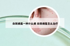 白斑病是一种什么病 白斑病是怎么治疗