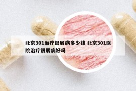北京301治疗银屑病多少钱 北京301医院治疗银屑病好吗