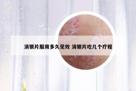 消银片服用多久见效 消银片吃几个疗程