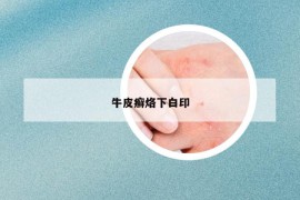 牛皮癣烙下白印