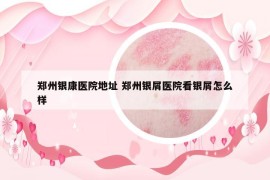 郑州银康医院地址 郑州银屑医院看银屑怎么样