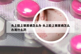 头上脸上银屑病怎么办 头上脸上银屑病怎么办用什么药