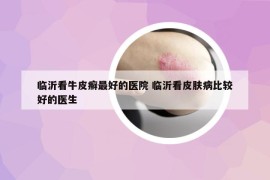 临沂看牛皮癣最好的医院 临沂看皮肤病比较好的医生