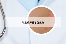 牛皮癣严重了怎么办