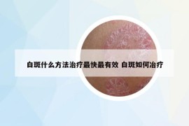 白斑什么方法治疗最快最有效 白斑如何冶疗