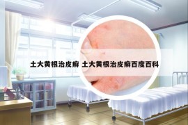 土大黄根治皮癣 土大黄根治皮癣百度百科