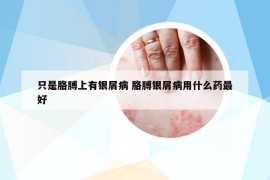 只是胳膊上有银屑病 胳膊银屑病用什么药最好