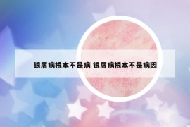 银屑病根本不是病 银屑病根本不是病因