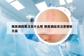 银屑病我要注意什么呢 银屑病应该注意哪些方面