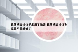 银屑病扁桃体手术用了激素 银屑病扁桃体割掉是不是就好了