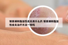 银屑病和脂溢性皮炎用什么药 银屑病和脂溢性皮炎治疗方法一样吗