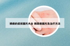 鳞癣的症状图片大全 鳞屑癣图片及治疗方法