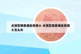 点滴型银屑病皮损很小 点滴型银屑病皮损很小怎么办