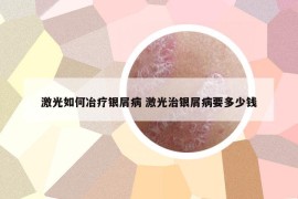 激光如何冶疗银屑病 激光治银屑病要多少钱