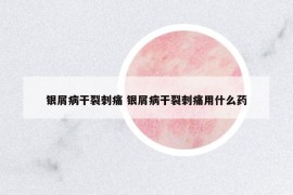 银屑病干裂刺痛 银屑病干裂刺痛用什么药