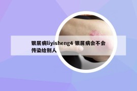 银屑病liyisheng4 银屑病会不会传染给别人