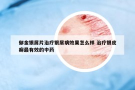 郁金银屑片治疗银屑病效果怎么样 治疗银皮癣最有效的中药