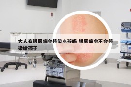 大人有银屑病会传染小孩吗 银屑病会不会传染给孩子