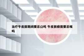 治疗牛皮藓期间要忌口吗 牛皮肤癣需要忌嘴吗