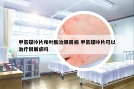 甲氨蝶呤片和叶酸治银屑病 甲氨蝶呤片可以治疗银屑病吗