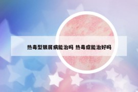 热毒型银屑病能治吗 热毒症能治好吗