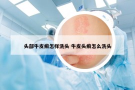 头部牛皮癣怎样洗头 牛皮头癣怎么洗头