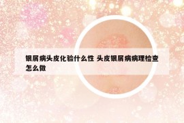 银屑病头皮化验什么性 头皮银屑病病理检查怎么做