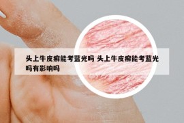 头上牛皮癣能考蓝光吗 头上牛皮癣能考蓝光吗有影响吗
