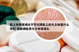 脸上有银屑病太干可以擦脸上的凡士林是什么样的 银屑病能用凡士林保湿么