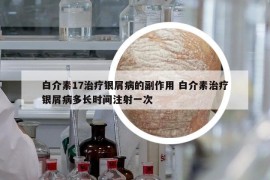 白介素17治疗银屑病的副作用 白介素治疗银屑病多长时间注射一次