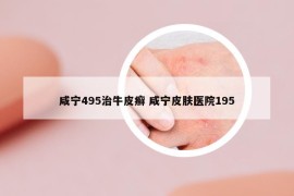咸宁495治牛皮癣 咸宁皮肤医院195