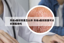 异维a酸软胶囊怎么样 异维a酸软胶囊可以长期服用吗