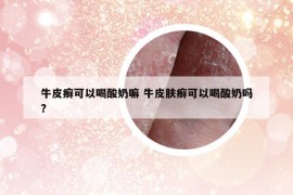 牛皮癣可以喝酸奶嘛 牛皮肤癣可以喝酸奶吗?
