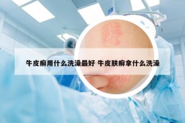 牛皮癣用什么洗澡最好 牛皮肤癣拿什么洗澡