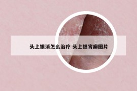 头上银消怎么治疗 头上银宵癣图片