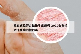 现在还没好办法治牛皮癣吗 2020会有根治牛皮癣的新药吗