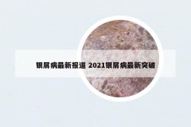 银屑病最新报道 2021银屑病最新突破