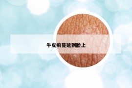 牛皮癣蔓延到脸上