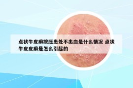 点状牛皮癣按压患处不出血是什么情况 点状牛皮皮癣是怎么引起的