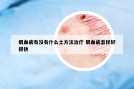 银血病有没有什么土方法治疗 银血病怎样好得快