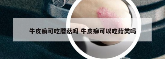 牛皮癣可吃蘑菇吗 牛皮癣可以吃菇类吗
