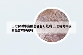 三七粉对牛皮癣患者有好处吗 三七粉对牛皮癣患者有好处吗