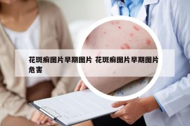 花斑癣图片早期图片 花斑癣图片早期图片 危害