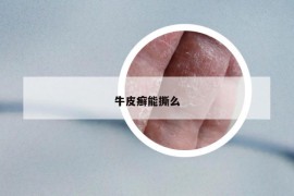 牛皮癣能撕么