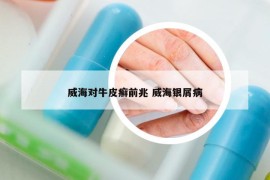 威海对牛皮癣前兆 威海银屑病
