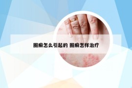 圈癣怎么引起的 圈癣怎样治疗