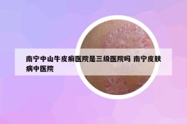 南宁中山牛皮癣医院是三级医院吗 南宁皮肤病中医院
